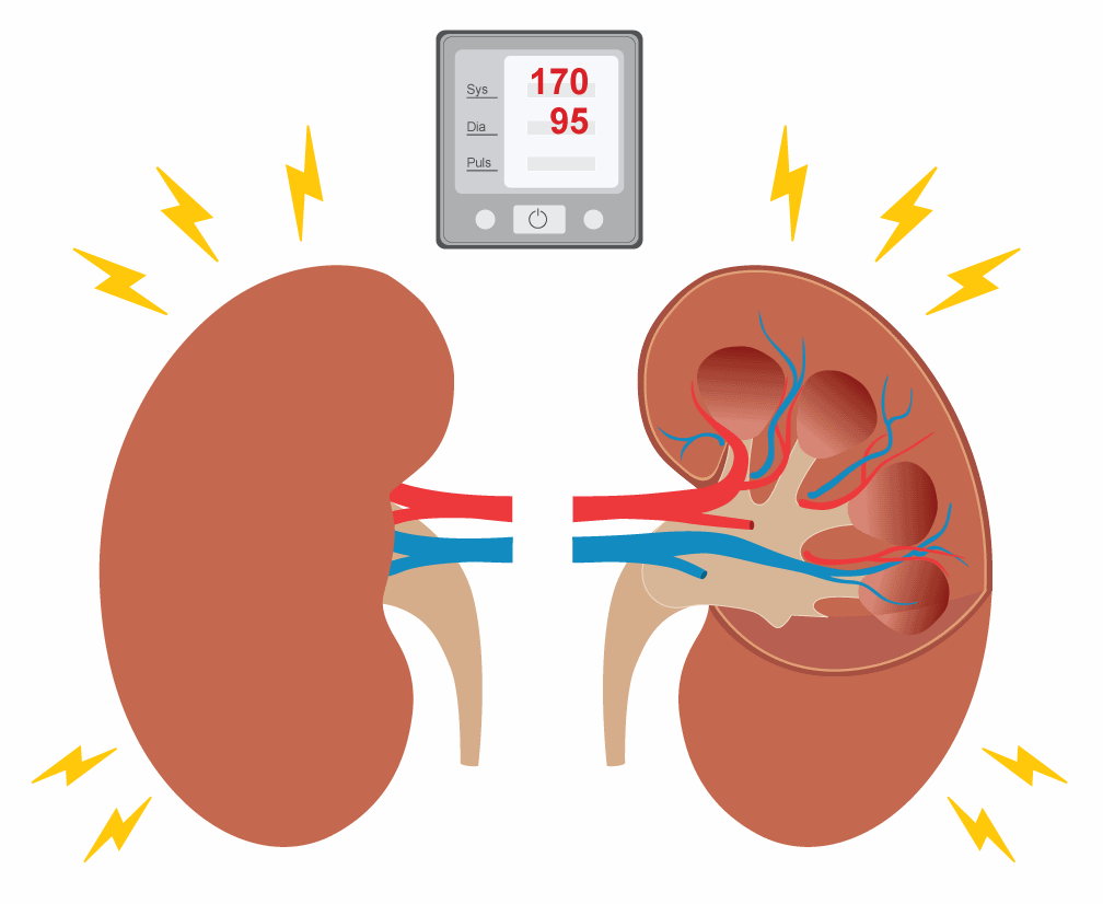 Bluthochdruck und Nieren